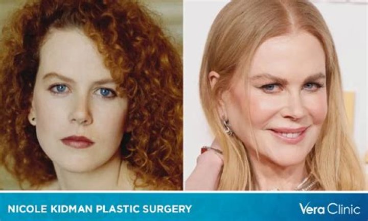 All About Nikole Kidman's Plastic Surgery Procedures: Before And After