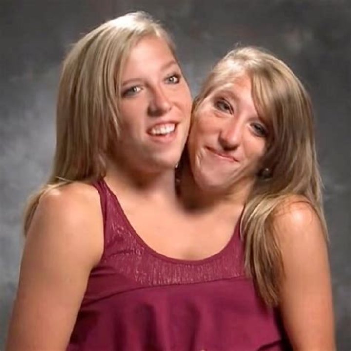 Exclusive: Conjoined Twins Abby And Brittany Hensel Expecting A Baby