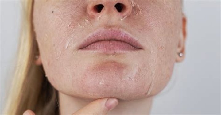 Get Rid Of Dry, Peeling Skin: Hisashi's Secret Revealed