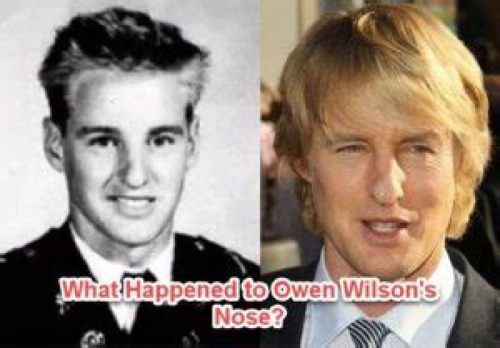 Unraveling The Mystery: Owen Wilson And His Nose